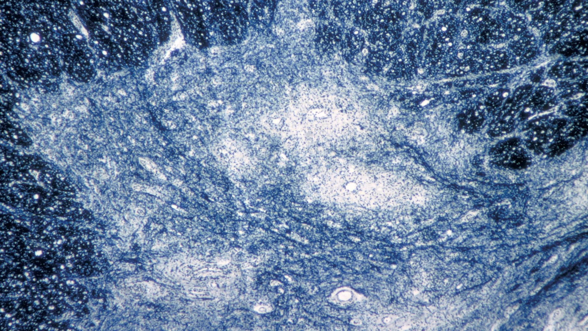 Imagen de microscopio de 1964 en la que se muestra el daño del virus de la polio en el tejido de la médula espinal