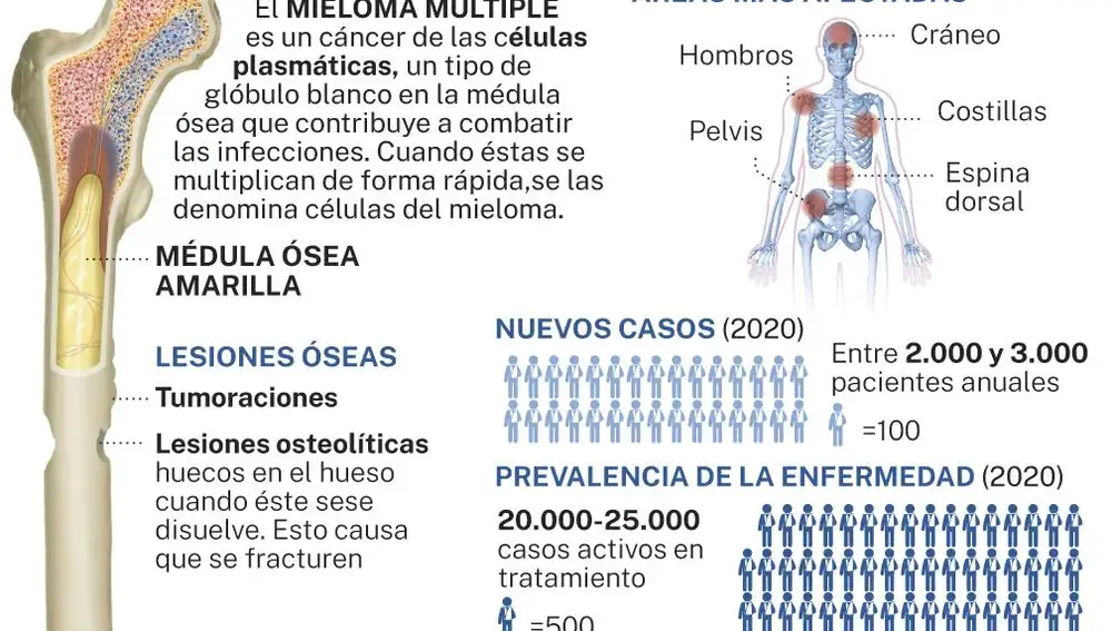 Mieloma múltiple