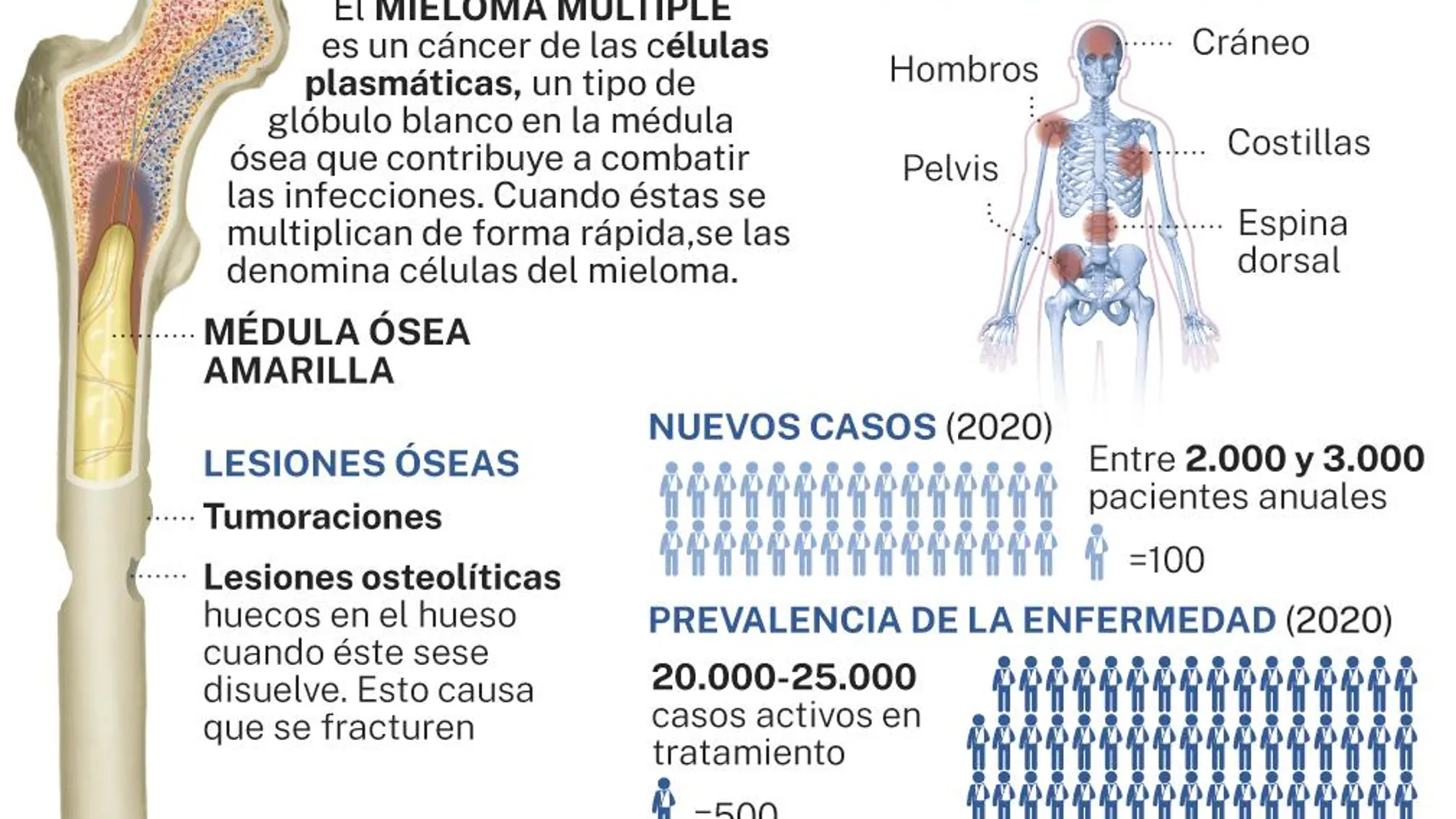 Mieloma Múltiple Se Cura