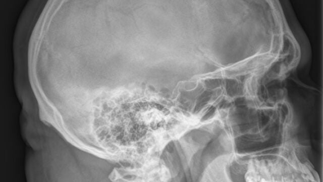 Radiografía de un cráneo en proyección sagital (de lado)