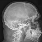 Radiografía de un cráneo en proyección sagital (de lado)