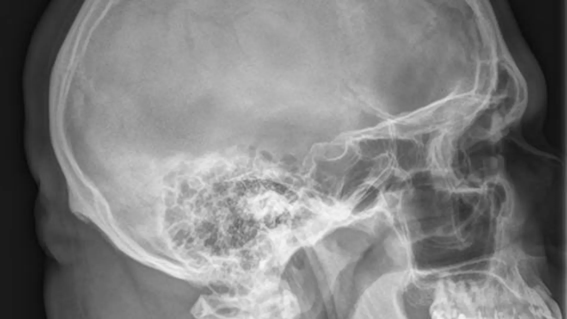 Radiografía de un cráneo en proyección sagital (de lado)