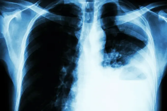 Hallan un prometedor avance en cáncer de pulmón resistente