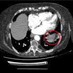 Tomografía computarizada con angiografía que muestra un área amorfa de consolidación similar a una masa en el lóbulo inferior izquierdo anterior en la base del pulmón izquierdo (círculo rojo).