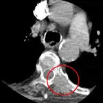 Tomografía computarizada de la columna torácica que muestra posibles metástasis óseas en las costillas (círculo rojo)