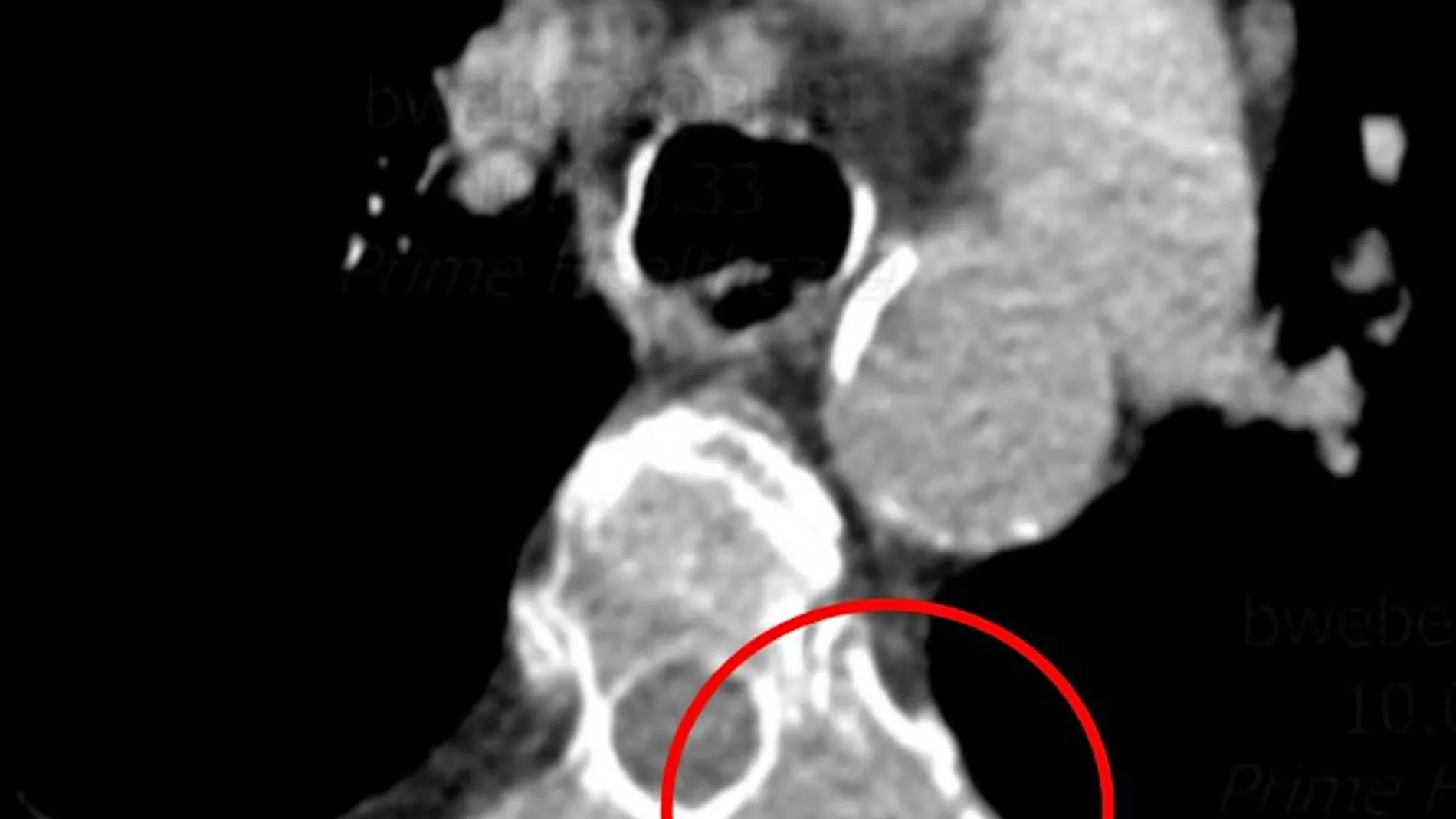 Tomografía computarizada de la columna torácica que muestra posibles metástasis óseas en las costillas (círculo rojo)