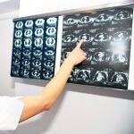 Los expertos recomiendan el uso de la tomografía de baja dosis de radiación como herramienta de «screening»