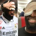 Rüdiger recibió 20 puntos de sutura tras una brecha en la cabeza