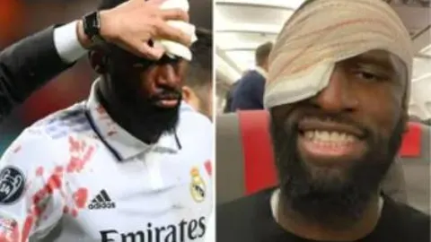 Rüdiger recibió 20 puntos de sutura tras una brecha en la cabeza