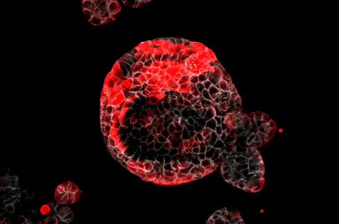 Identificadas las células responsables de la recaída en el cáncer de colon 