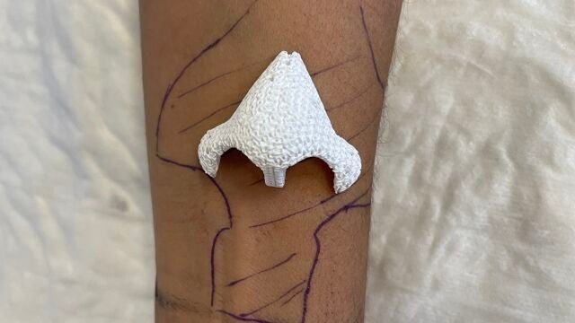 Imagen del implante sobre el brazo de la paciente antes de realizarle el injerto
