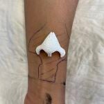 Imagen del implante sobre el brazo de la paciente antes de realizarle el injerto