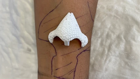Imagen del implante sobre el brazo de la paciente antes de realizarle el injerto