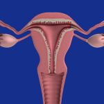 El hiperandrogenismo ovárico funcional, más conocido como síndrome de ovarios poliquísticos (SOP), es un desorden hormonal provocado por una alteración de la función ovárica.