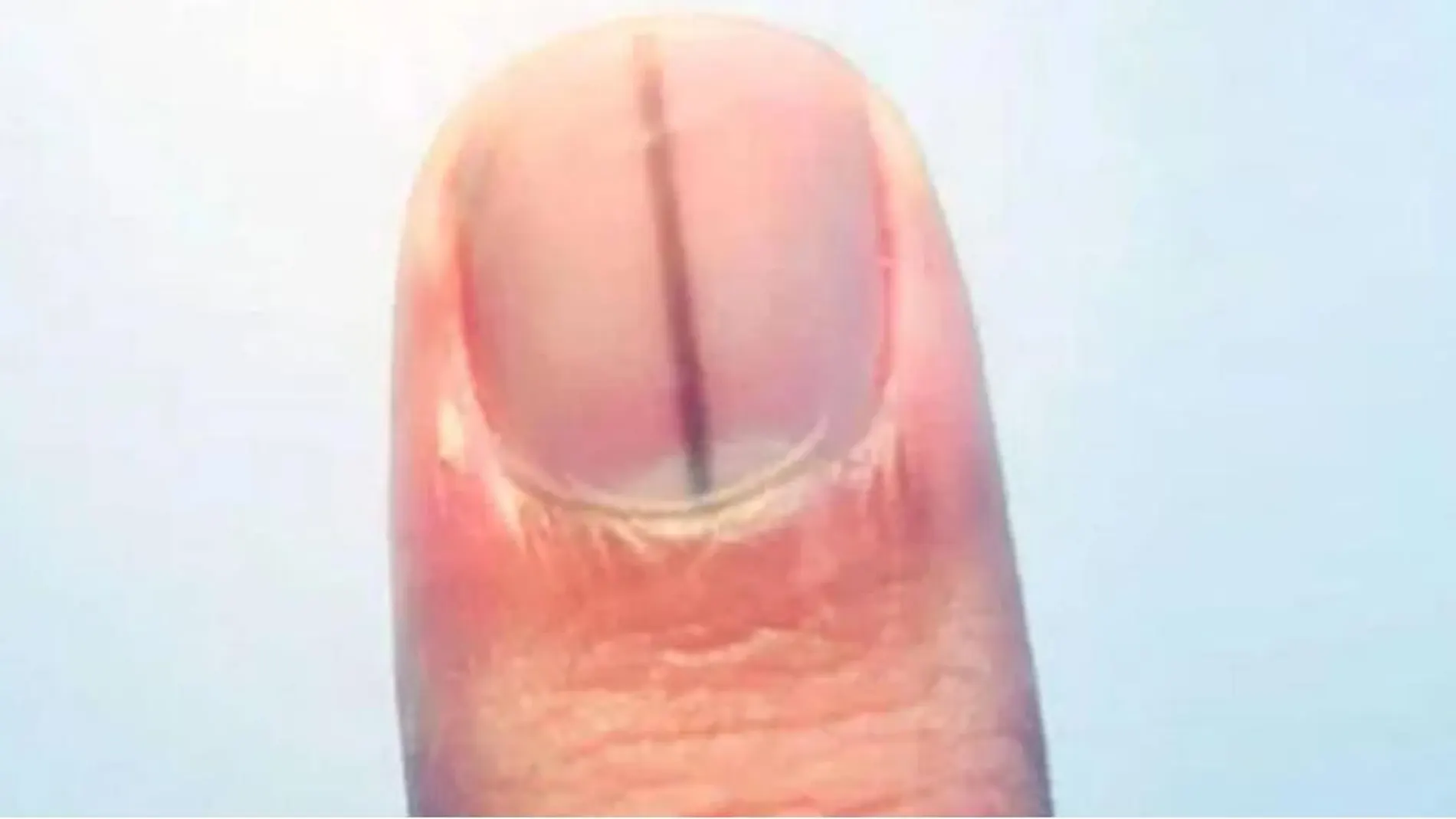 Una línea negra trasversal en la uña podría ser la manifestación de un melanoma| Fuente: Lashkar.in