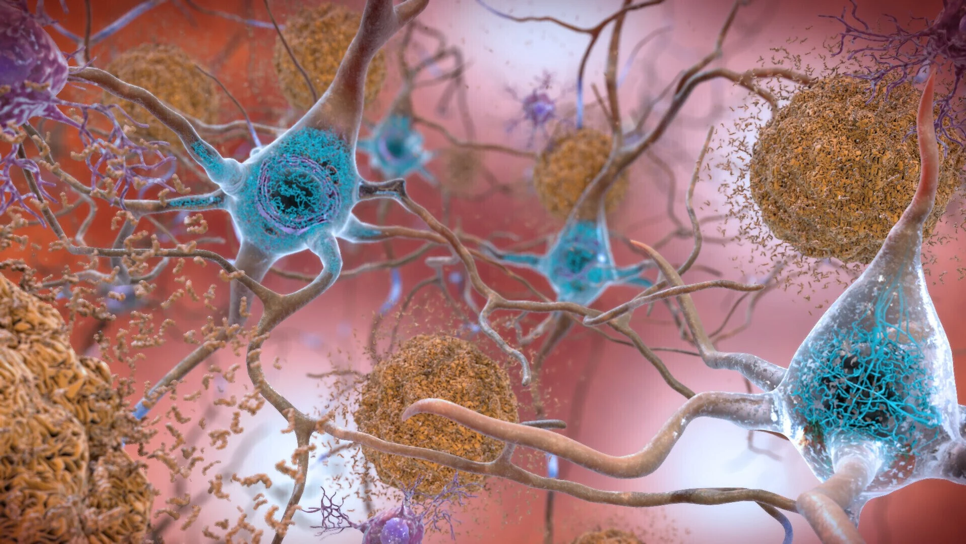 Células en un cerebro afectado por la enfermedad de Alzheimer