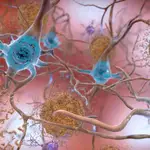 Células en un cerebro afectado por la enfermedad de Alzheimer