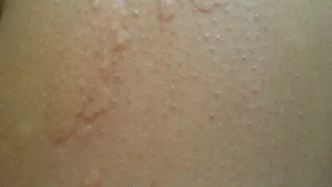 Urticaria alérgica en forma de ampollas inducidas por frío.