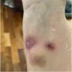La enfermedad produce ampollas en la piel 