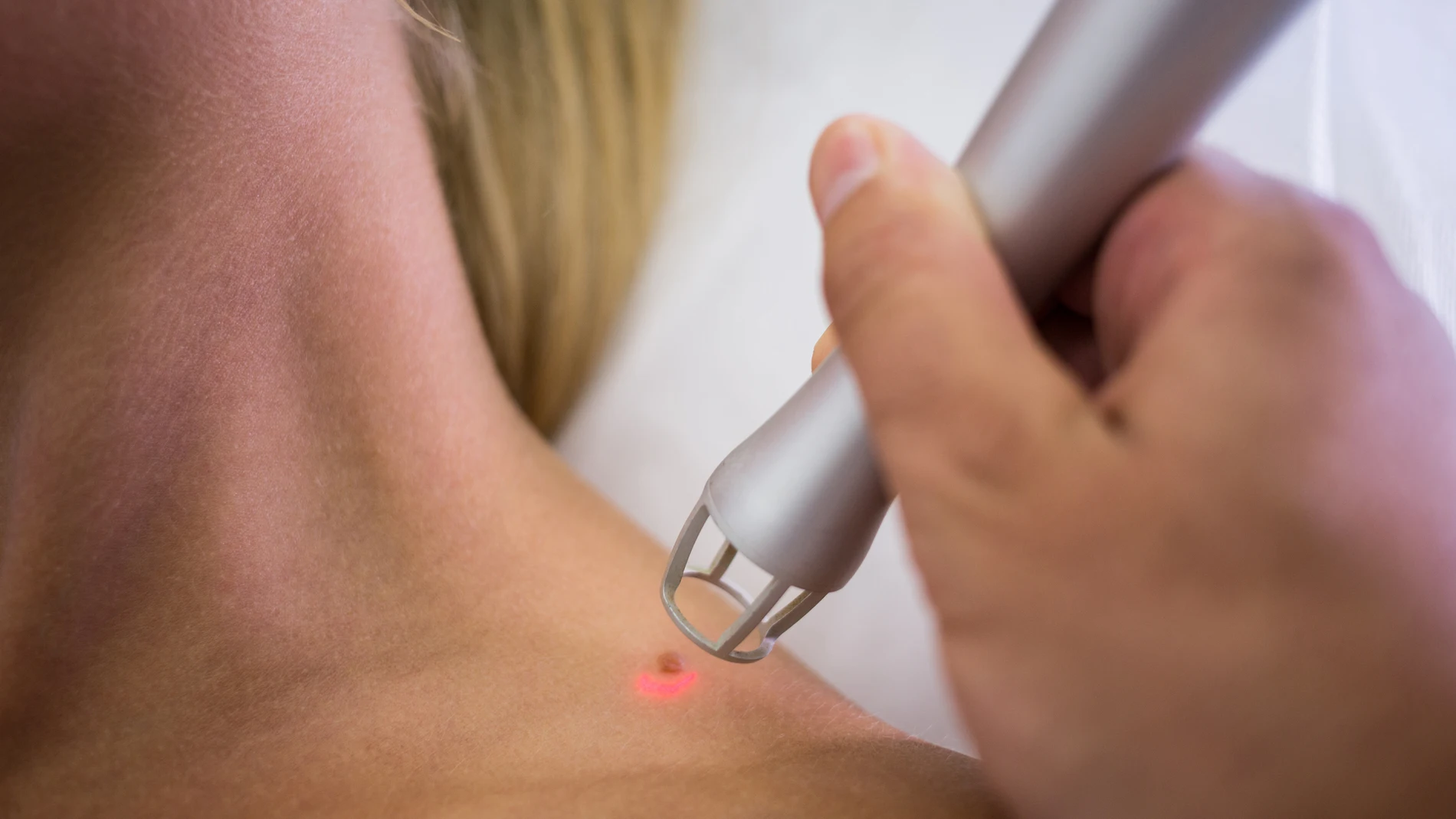 Una vacuna experimental logra la remisión del cáncer de piel en personas con melanoma de alto riesgo