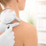 Melanoma en gente joven