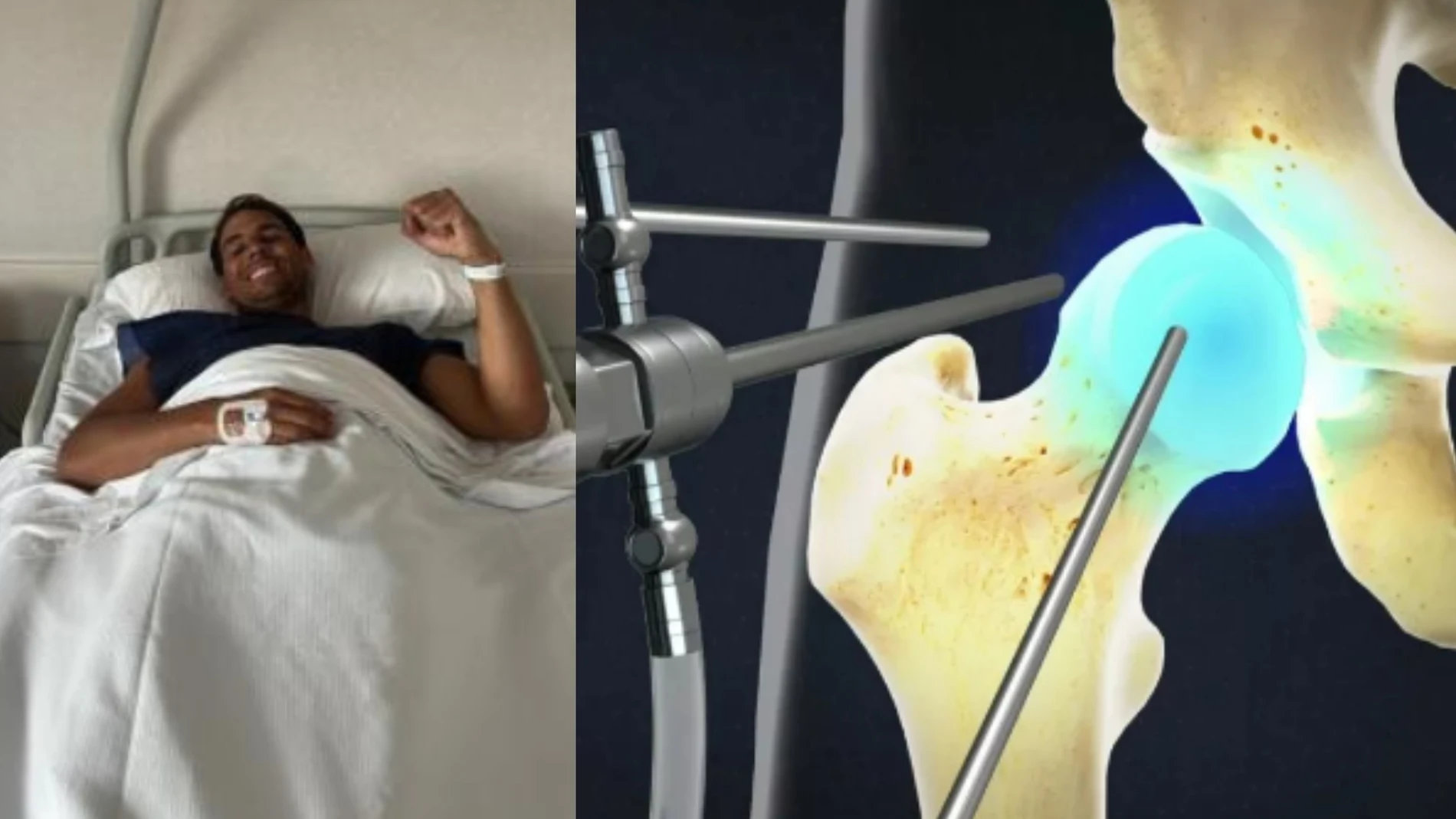 ¿En que consiste la operación de Rafa Nadal y cual es su tiempo de recuperación?: claves para entender su dolorosa lesión