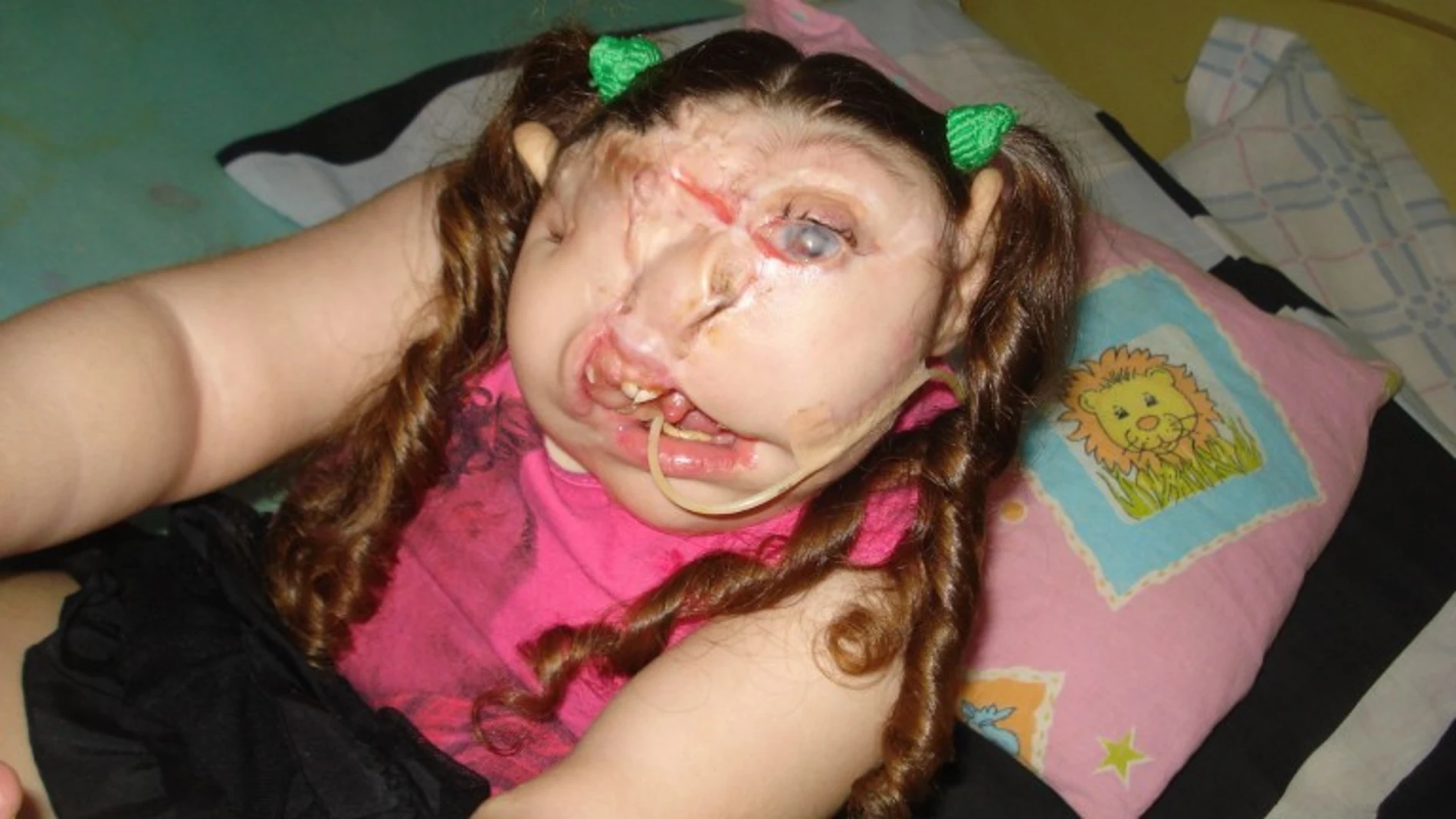 Vitoria tenía sus ojos, nariz y boca desplazados a un lado de la cara debido a la rara enfermedad que sufría