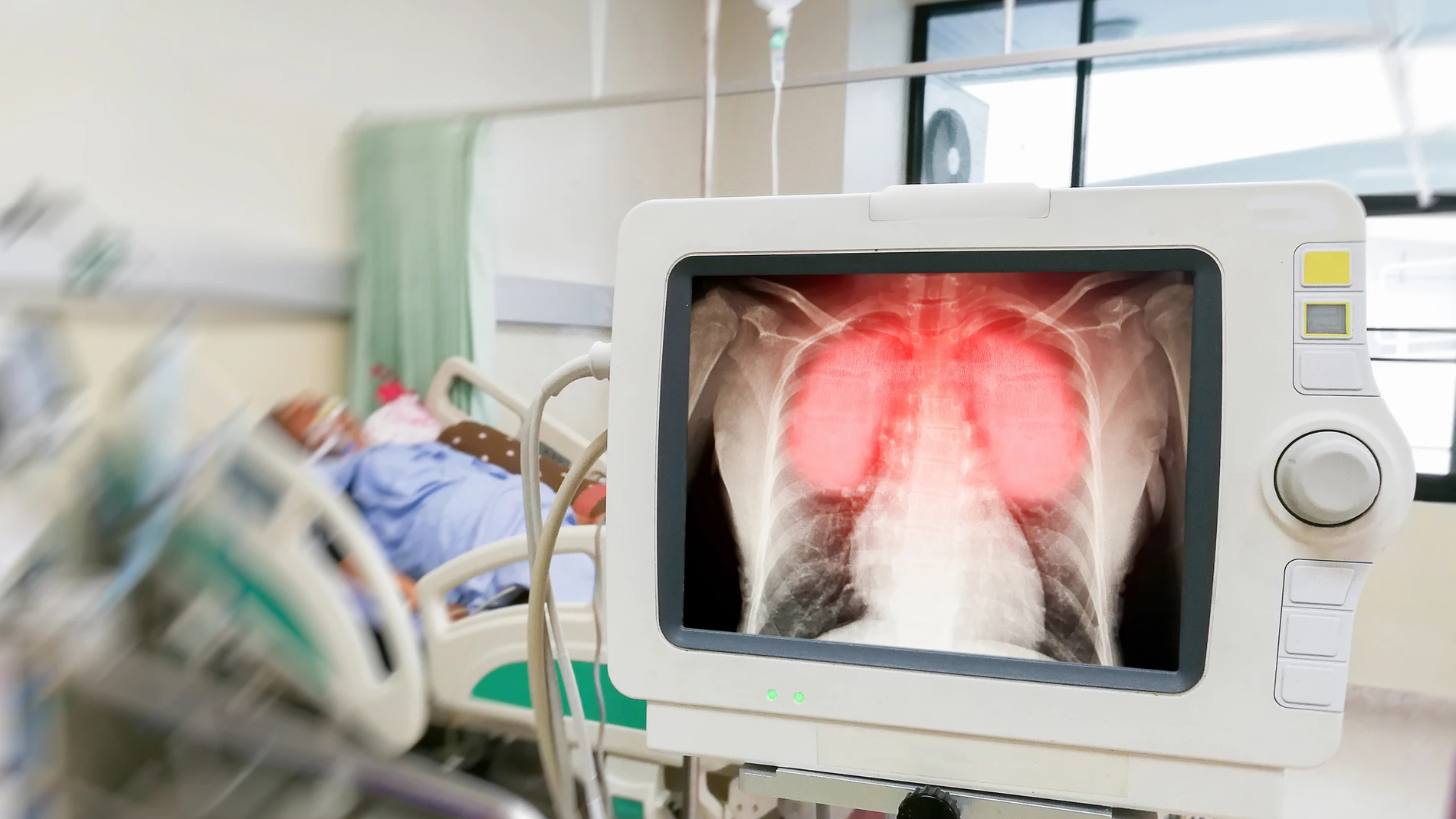 Human coronavirus lung Inflammation and infection show on screen in hospital patients.