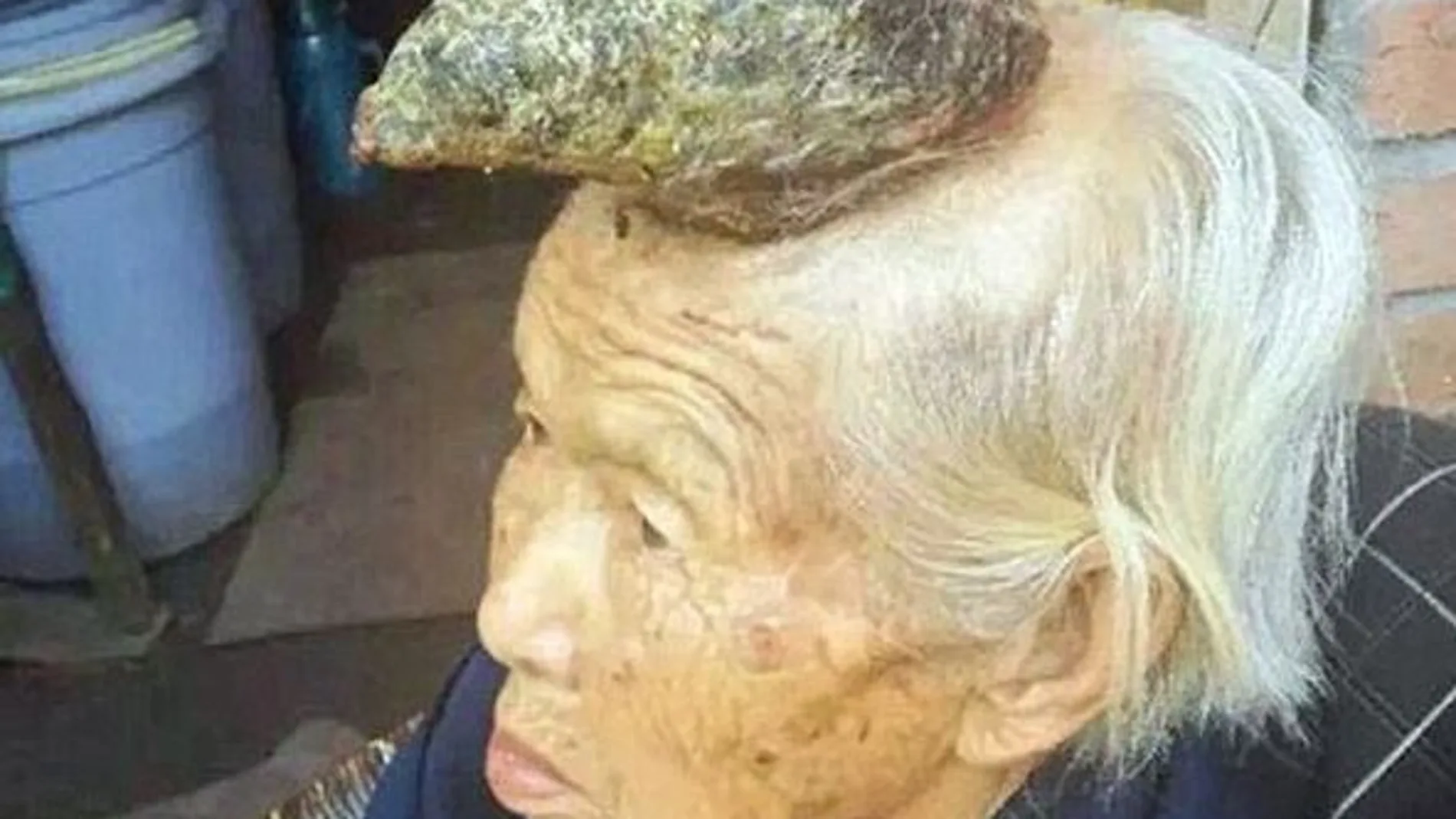 Liang Xiuzhen, con 87 años, se convirtió en "la mujer unicornio" al presentar un cuerno cutáneo de 13 centímetros