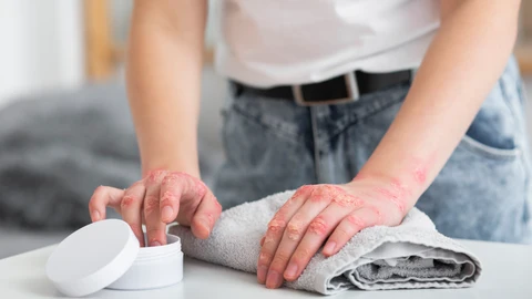 Psoriasis