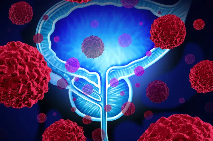 Un análisis de orina suficiente para detectar cáncer de próstata
