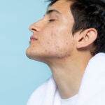 Las causas de la aparición del acné son multifactoriales