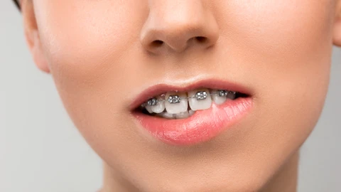 Mujer con aparato de dientes