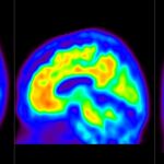  imágenes de escáner cerebral con PET amiloide.