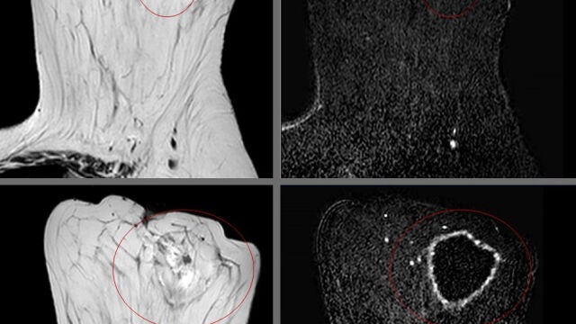 Imágenes de resonancia magnética del tumor (arriba) y de la posterior ablación (abajo)