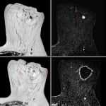 Imágenes de resonancia magnética del tumor (arriba) y de la posterior ablación (abajo)