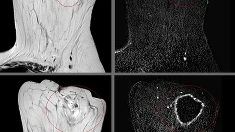 Imágenes de resonancia magnética del tumor (arriba) y de la posterior ablación (abajo)