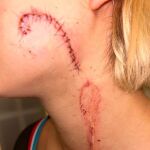 La mujer quedó con una enorme cicatriz en el rostro