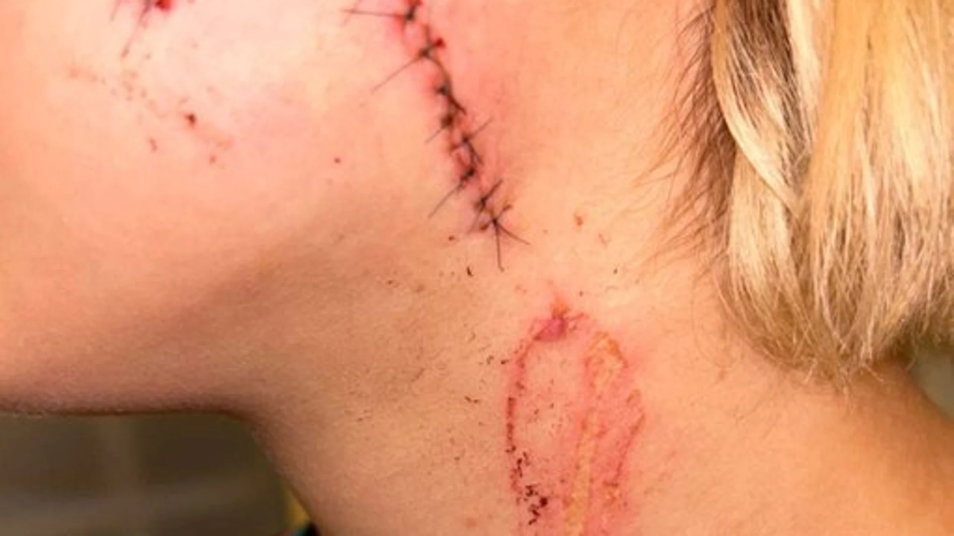 La mujer quedó con una enorme cicatriz en el rostro