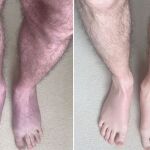 Dos imágenes de las piernas del paciente tras 10 minutos de pie