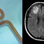 El gusanoque los cirujanos del hospital de Canberra extrajeron viva del cerebro de la mujer.