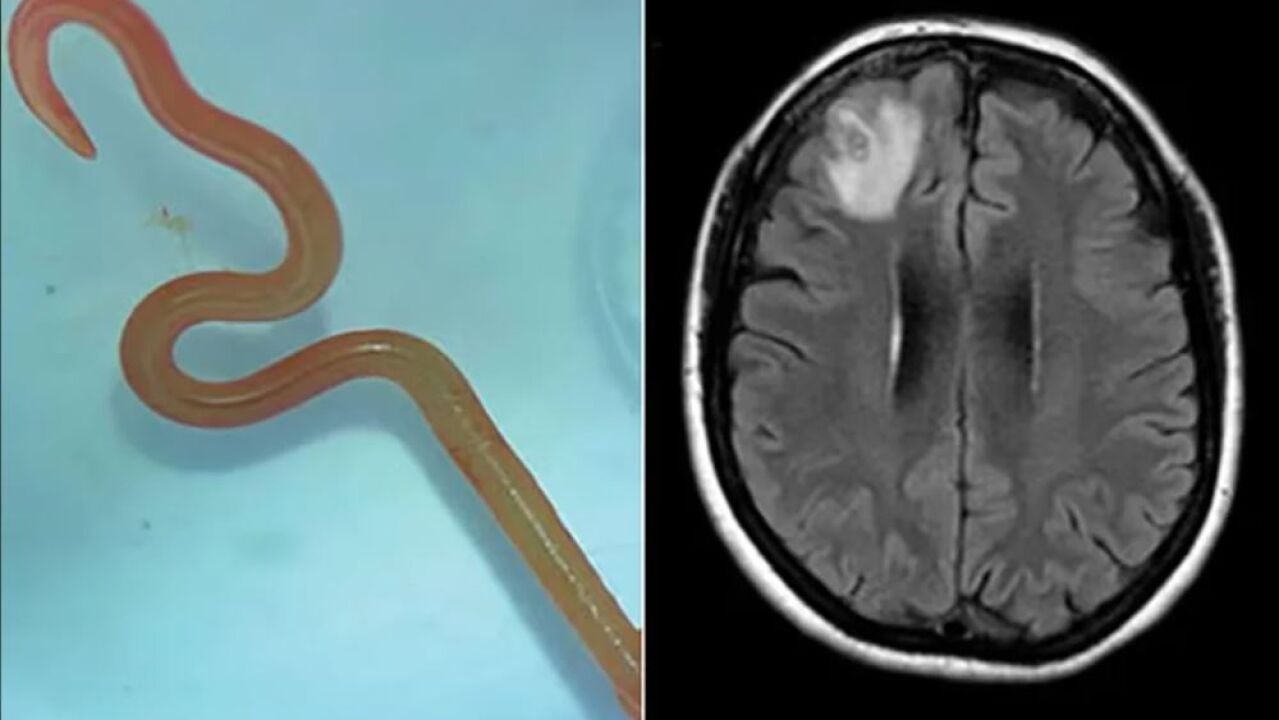 Extraen un gusano de 8 cm del cerebro de una mujer: "Nadie pensó encontrarlo ahí vivo y y retorciéndose"