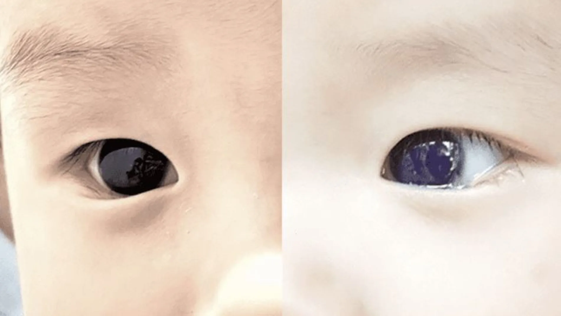 Los ojos de un bebé cambian de color después de recibir un tratamiento contra la Covid-19