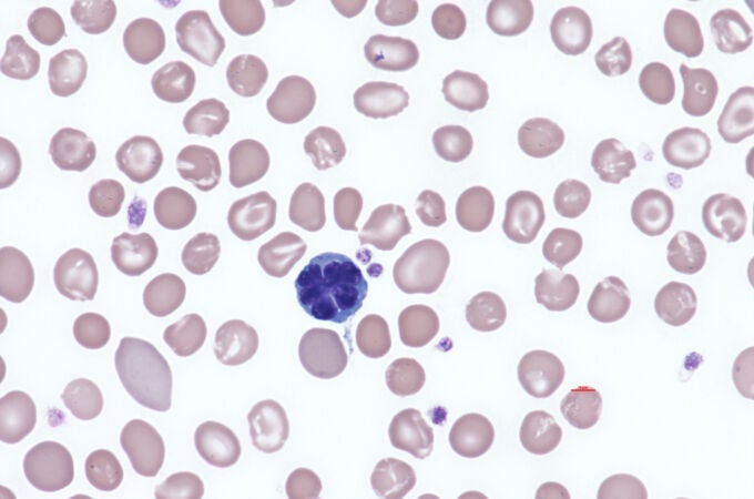 Virus HTLV-1 casusante de la Leucemia