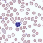 Virus HTLV-1 casusante de la Leucemia