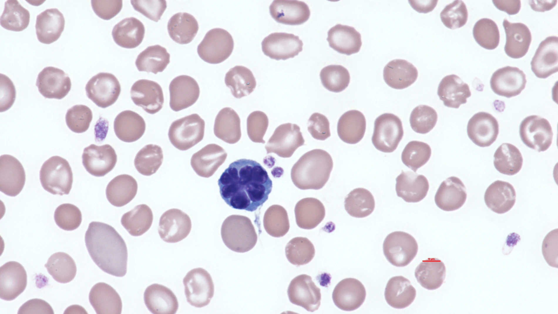 Virus HTLV-1 casusante de la Leucemia