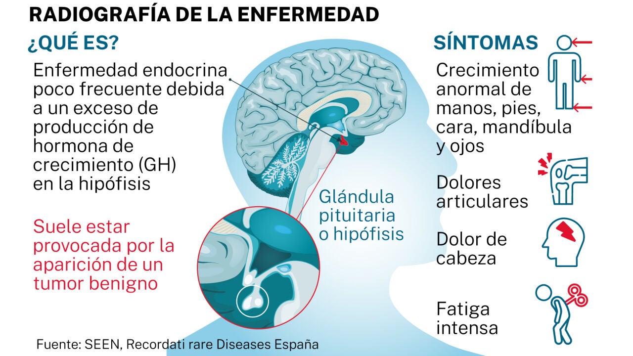 Acromegalia, uma doença rara com boas notícias