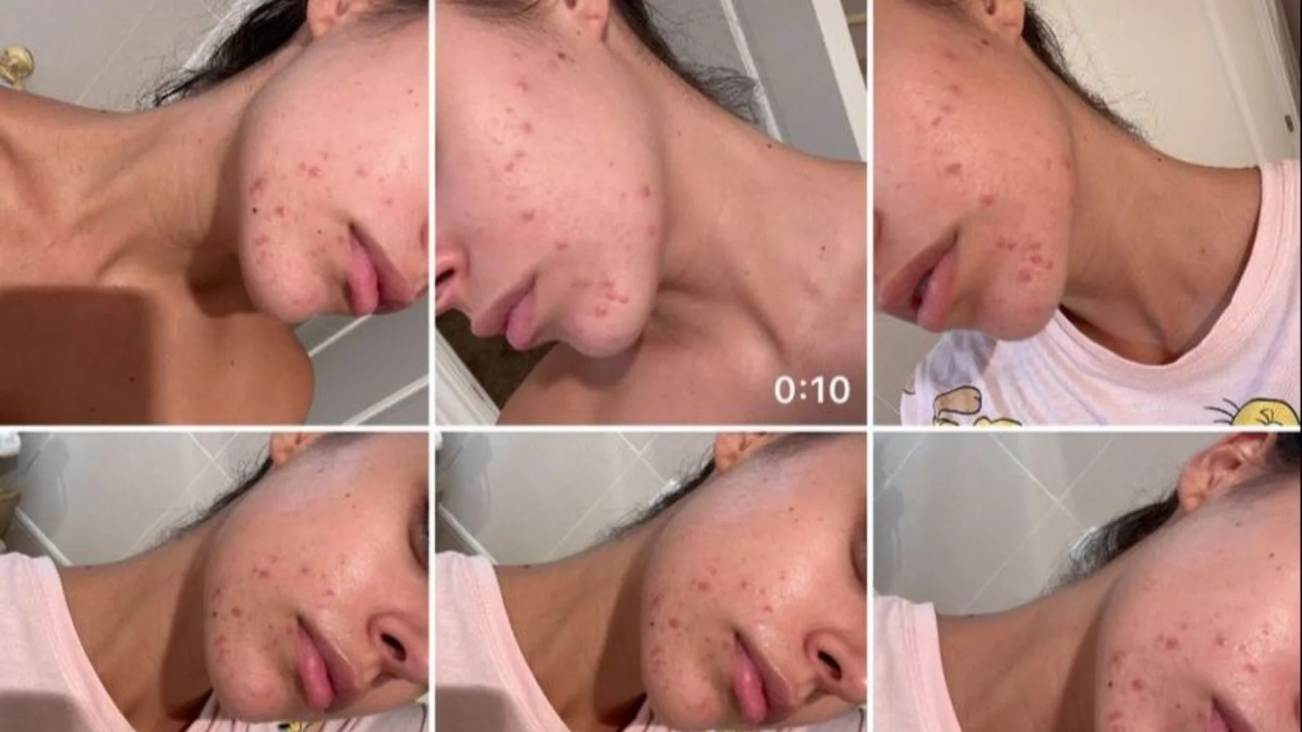 Marta Díaz comparte su batalla con el acné: "Estoy peor que nunca"