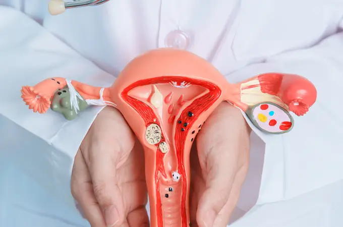 Cómo convivir con el síndrome de ovarios poliquísticos