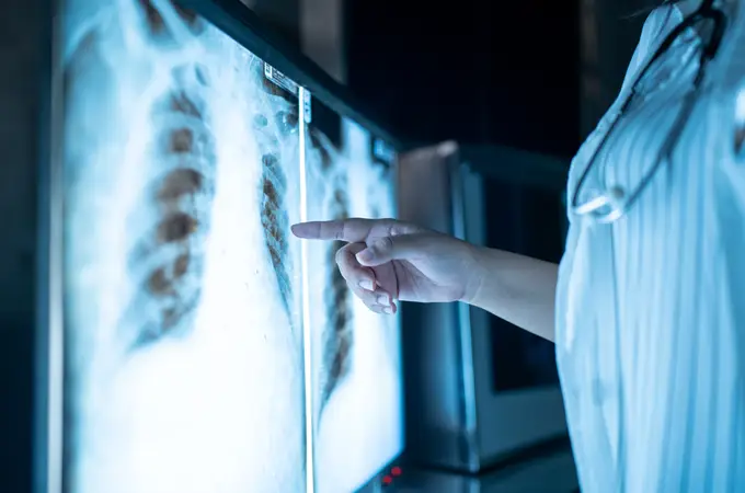 El 38,6% de los pacientes con cáncer de pulmón espera más de tres semanas desde la biopsia hasta los resultados